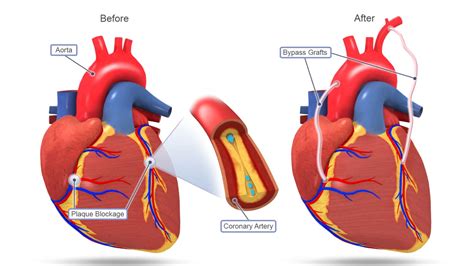 dr james ho khe sui|Atrial fibrillation, a complication of coronary artery bypass surgery .